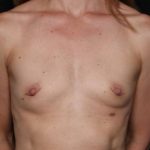 Breast Augmentation - Round Silicone Implants Before & After Patient #32594