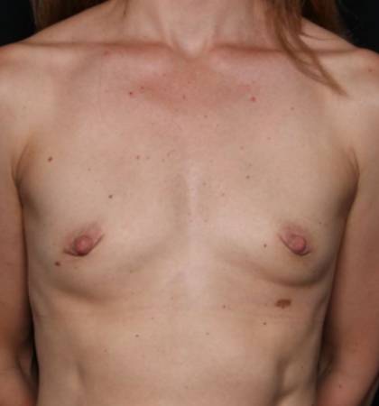 Breast Augmentation - Round Silicone Implants Before & After Patient #32594