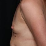 Breast Augmentation - Round Silicone Implants Before & After Patient #32594