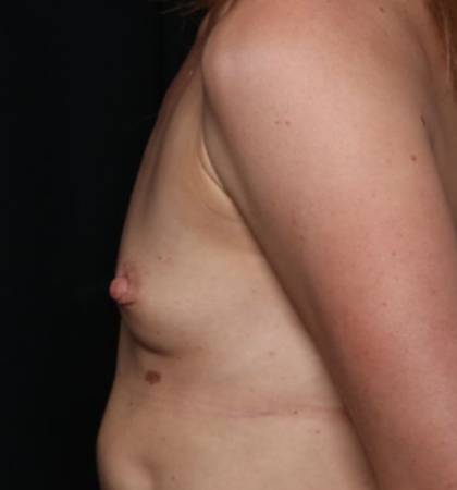 Breast Augmentation - Round Silicone Implants Before & After Patient #32594