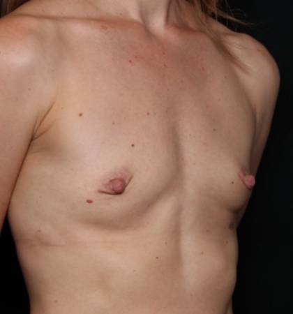 Breast Augmentation - Round Silicone Implants Before & After Patient #32594