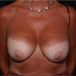 Breast Implant Exchange Before & After Patient #32873