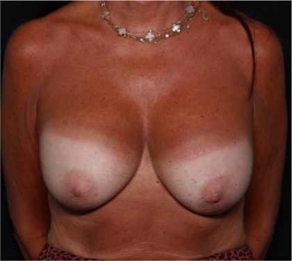 Breast Implant Exchange Before & After Patient #32873
