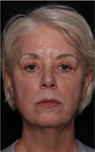 Facelift Before & After Patient #32910