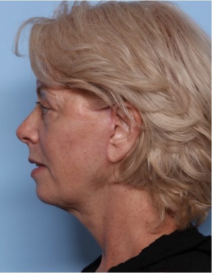 Facelift Before & After Patient #32910