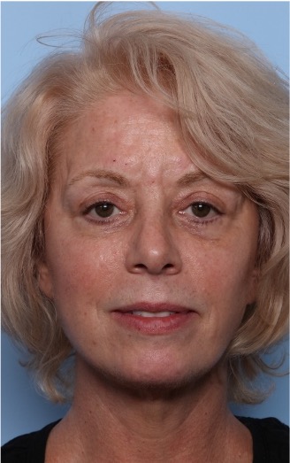 Facelift Before & After Patient #32910