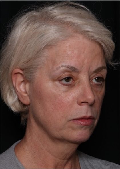 Facelift Before & After Patient #32910