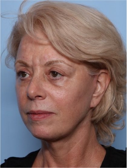 Facelift Before & After Patient #32910