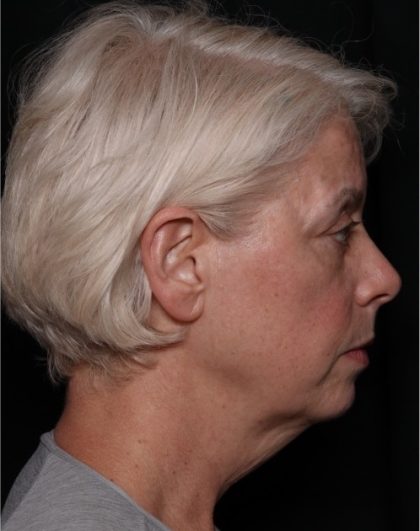 Facelift Before & After Patient #32910