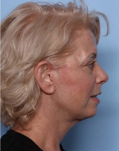 Facelift Before & After Patient #32910