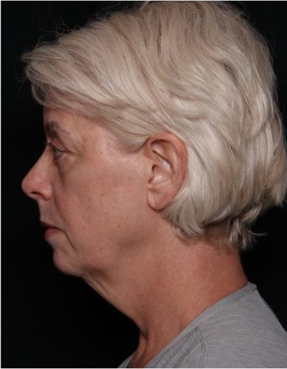 Facelift Before & After Patient #32910