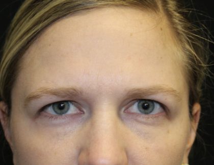 Brow Lift Before & After Patient #32896