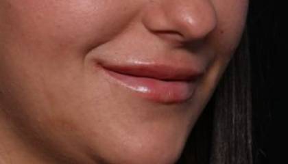 Lip Filler Before & After Patient #32863