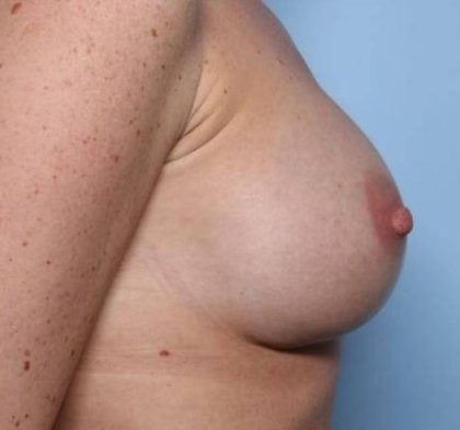 Breast Augmentation - Round Silicone Implants Before & After Patient #32921