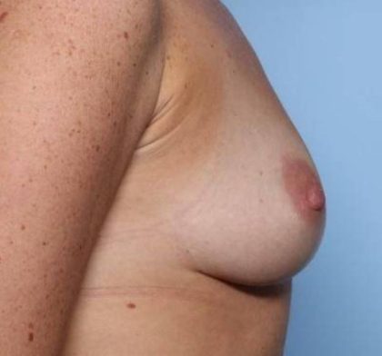 Breast Augmentation - Round Silicone Implants Before & After Patient #32921