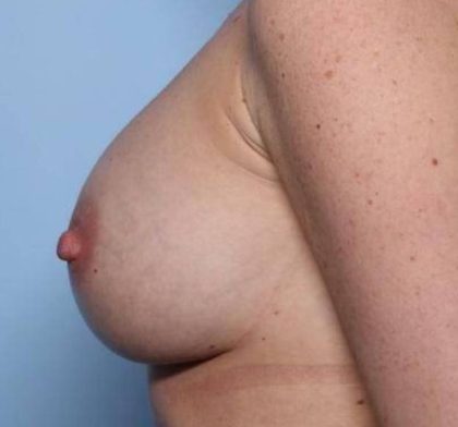 Breast Augmentation - Round Silicone Implants Before & After Patient #32921