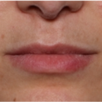 Lip Filler Before & After Patient #32954