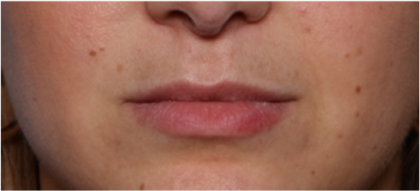 Lip Filler Before & After Patient #32954