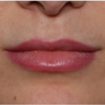 Lip Filler Before & After Patient #32954