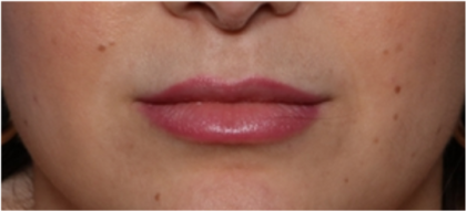 Lip Filler Before & After Patient #32954