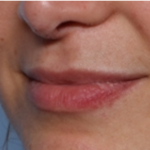 Lip Filler Before & After Patient #32954