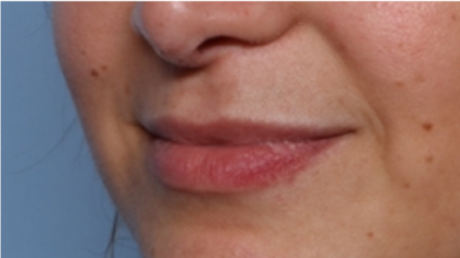 Lip Filler Before & After Patient #32954