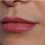 Lip Filler Before & After Patient #32954