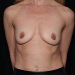 Breast Augmentation Before & After Patient #32932