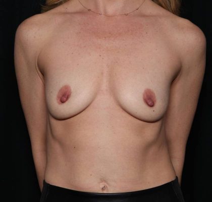 Breast Augmentation Before & After Patient #32932