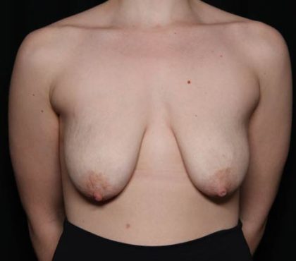 Breast Lift Before & After Patient #33085