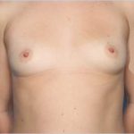 Breast Augmentation Before & After Patient #33098