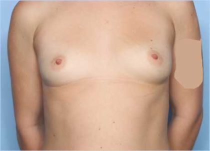 Breast Augmentation Before & After Patient #33098