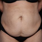 Liposuction Before & After Patient #33174