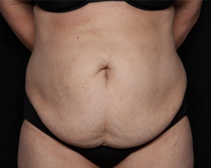 Liposuction Before & After Patient #33174