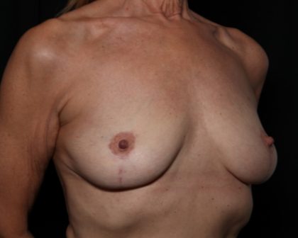 Breast Lift Before & After Patient #33185