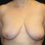 Breast Reduction Before & After Patient #33052