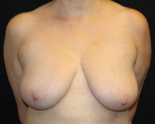 Breast Reduction Before & After Patient #33052