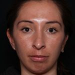 Chin Augmentation Before & After Patient #33041
