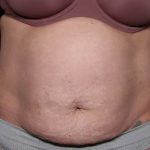 Tummy Tuck Before & After Patient #33063