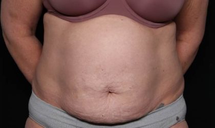 Tummy Tuck Before & After Patient #33063