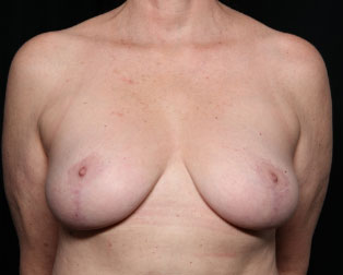 Breast Reduction Before & After Patient #33052