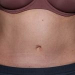 Tummy Tuck Before & After Patient #33063