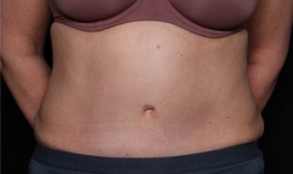 Tummy Tuck Before & After Patient #33063