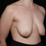 Breast Lift Before & After Patient #33085