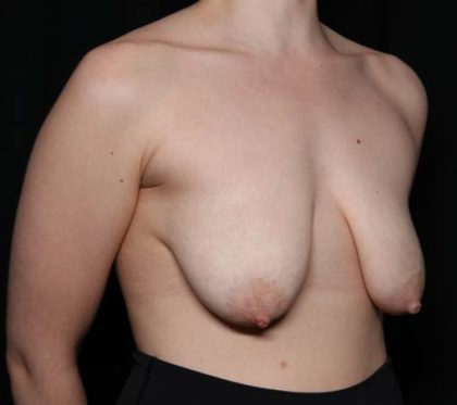 Breast Lift Before & After Patient #33085