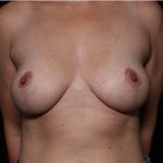 Breast Lift Before & After Patient #33163