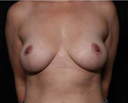 Breast Lift Before & After Patient #33163