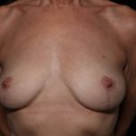 Breast Lift Before & After Patient #33185