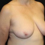 Breast Reduction Before & After Patient #33052