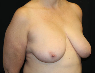Breast Reduction Before & After Patient #33052